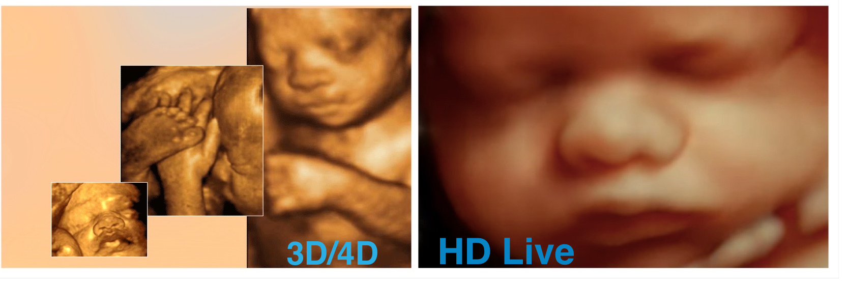 4D Ultrasound, 3D Ultrasound, 5D Ultrasound, HD Live Ultrasound